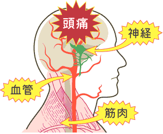 Lesson1 頭痛をよく知る 脳外科医と考える頭痛ａｔｏｚ 頭痛外来 北見クリニック